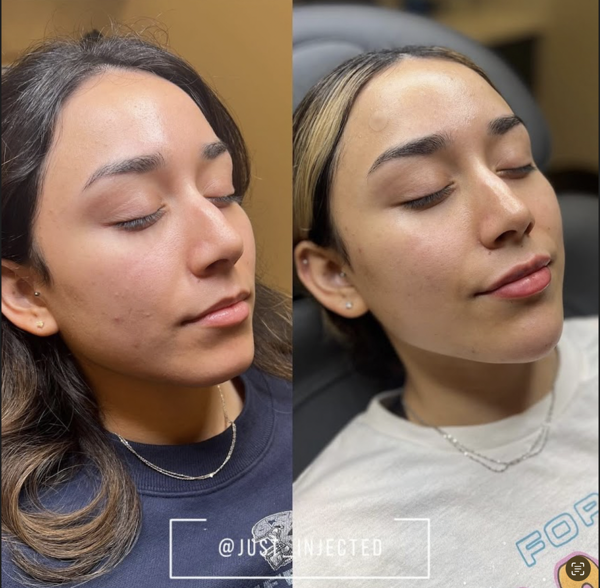 Cheek filler before and after Dallas — lifted contour and midface volume by Justine Lewis APRN