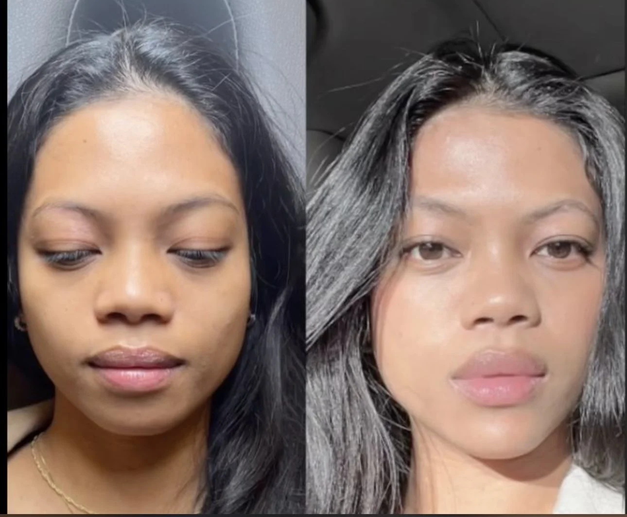 Facial fillers at Just Injected in University Park, Dallas.