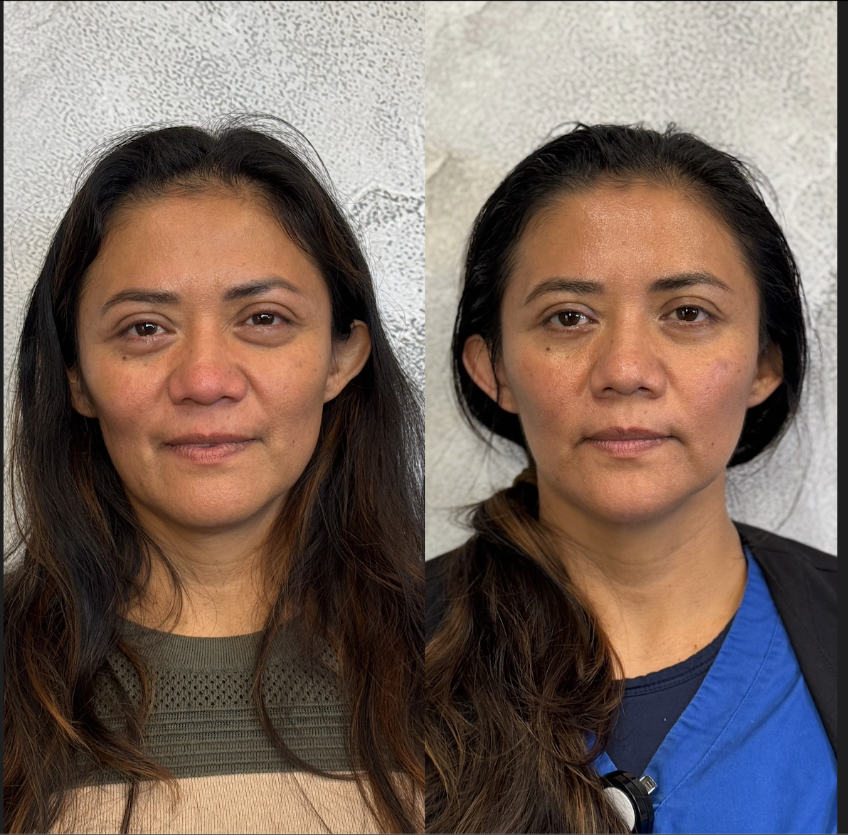 Mid-face filler Dallas showing natural cheek definition