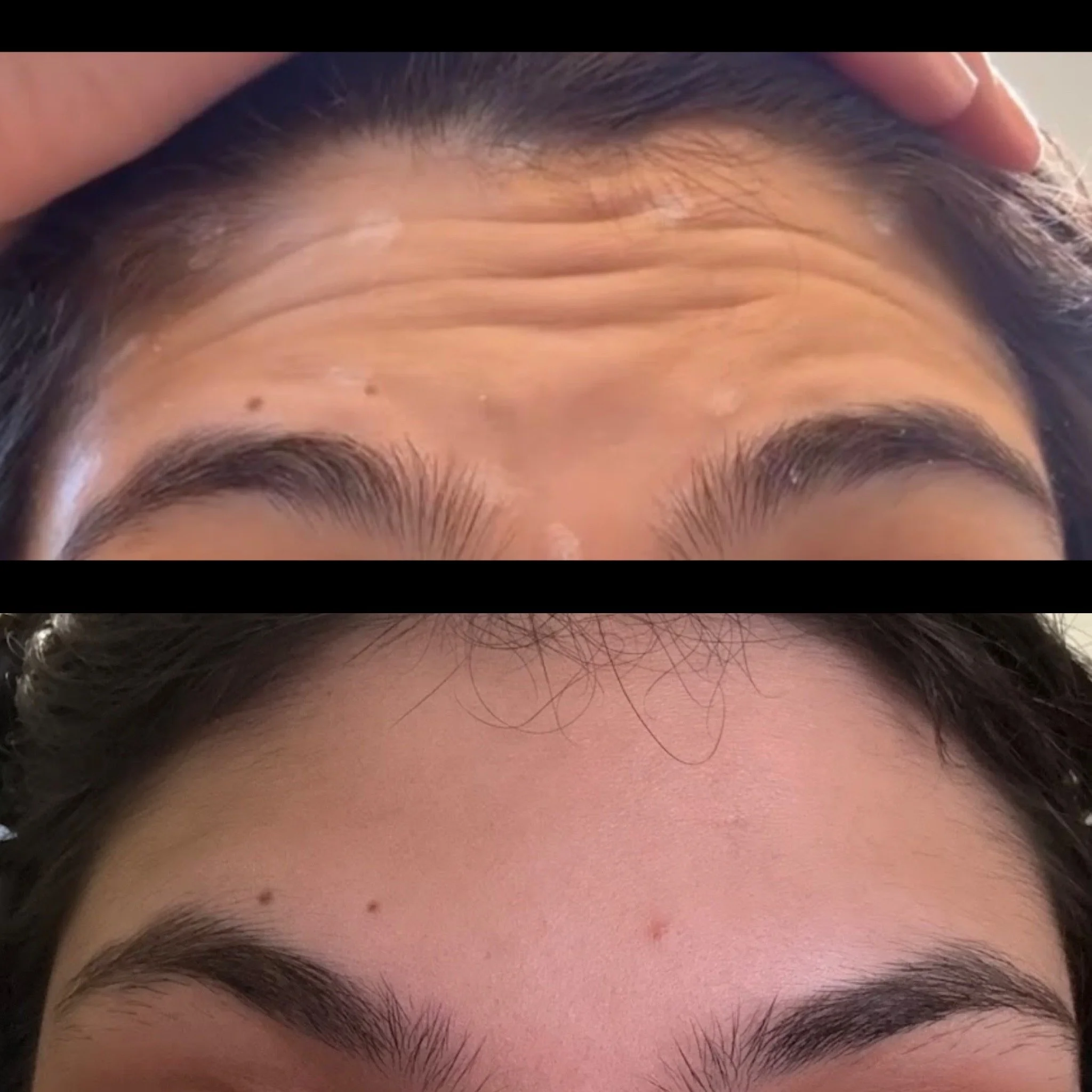 Botox at Just Injected in Dallas