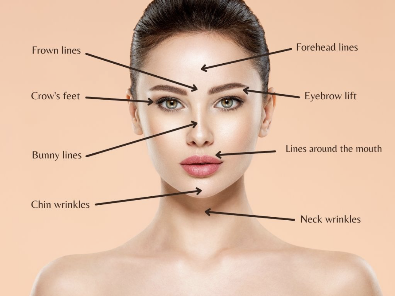 Where to get Dysport injected