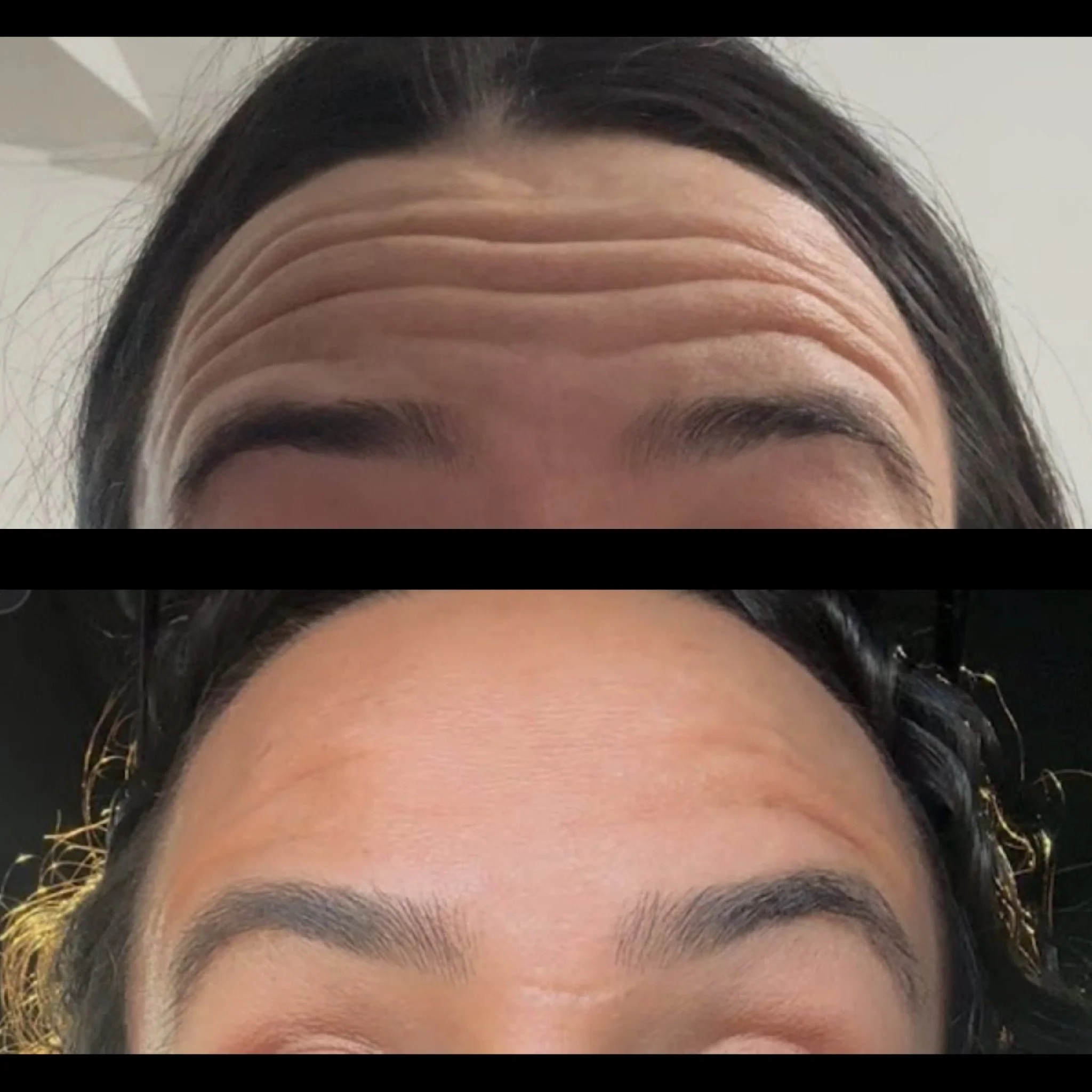 Forehead Dysport Dallas