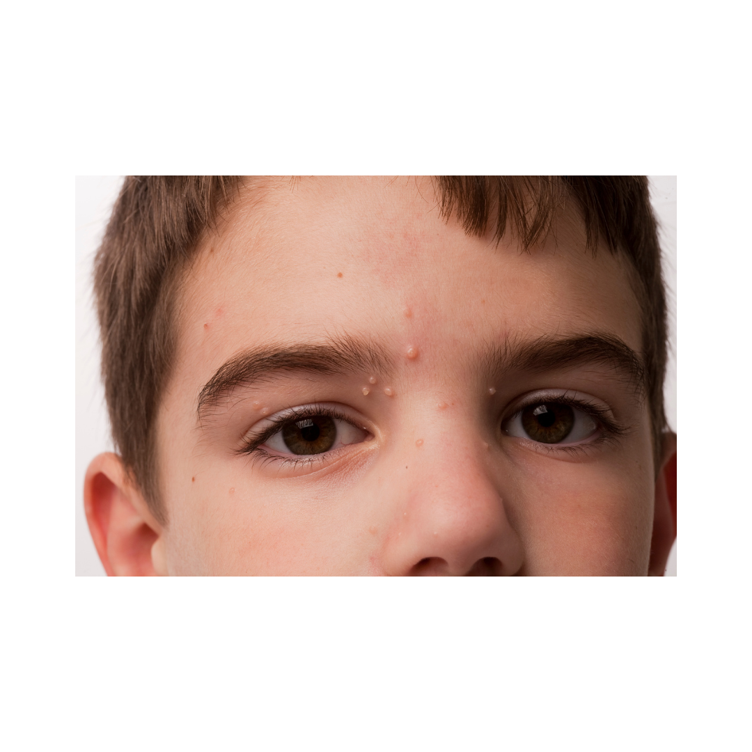 molluscum contagiosum