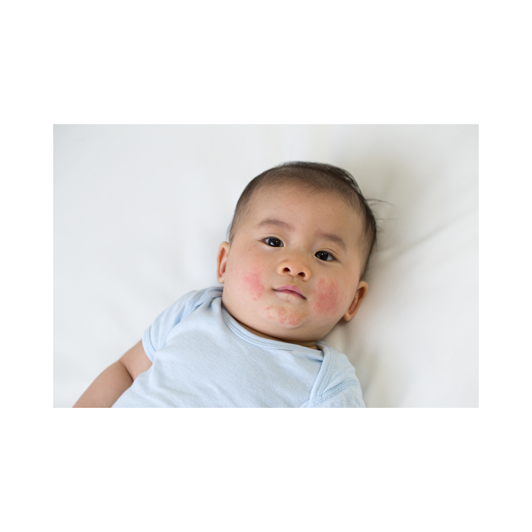 how to grade your child’s eczema (and why this matters!)