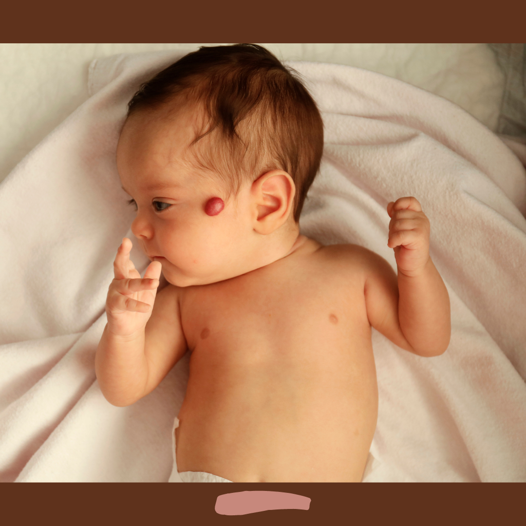 infantile hemangiomas