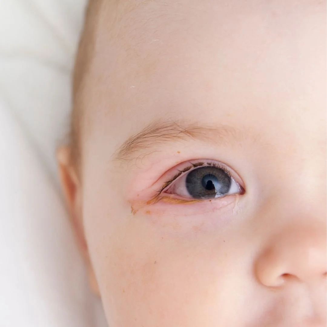 Tips for Pinkeye (Conjunctivitis)