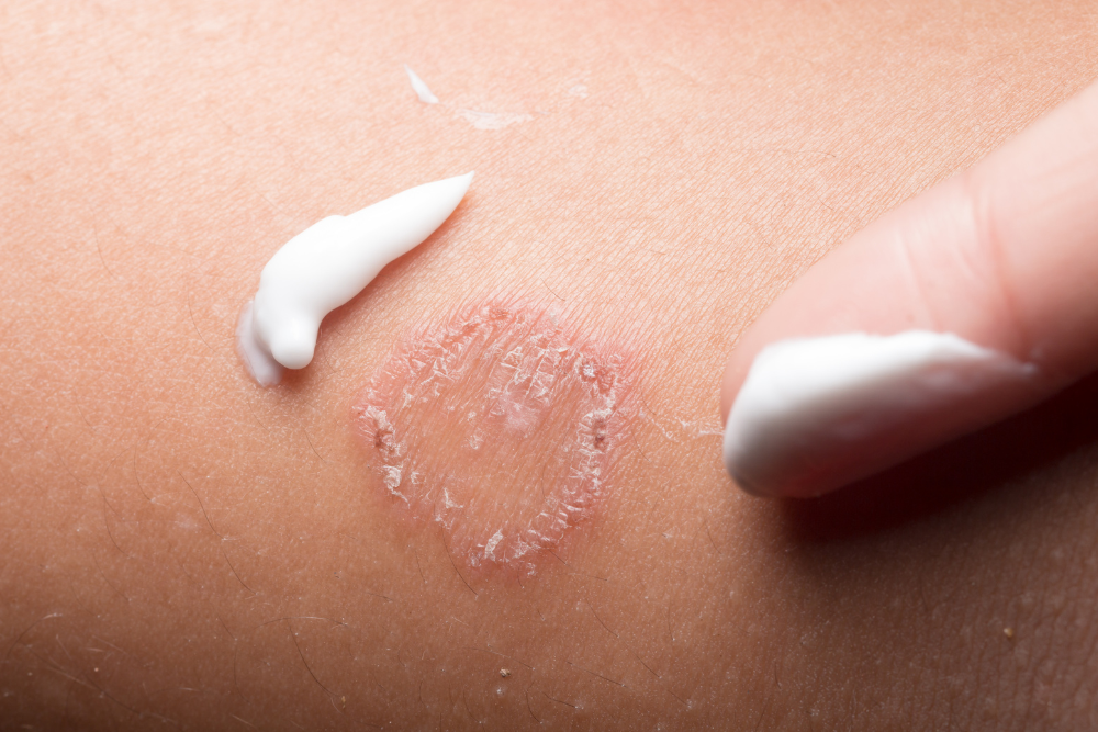 What to Know about Ringworm