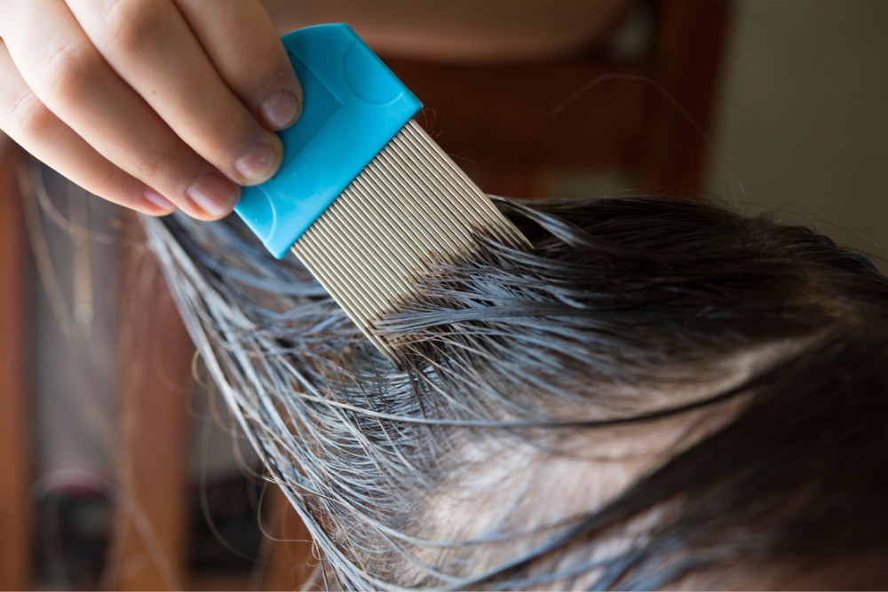 A Step-by-Step Guide to Lice