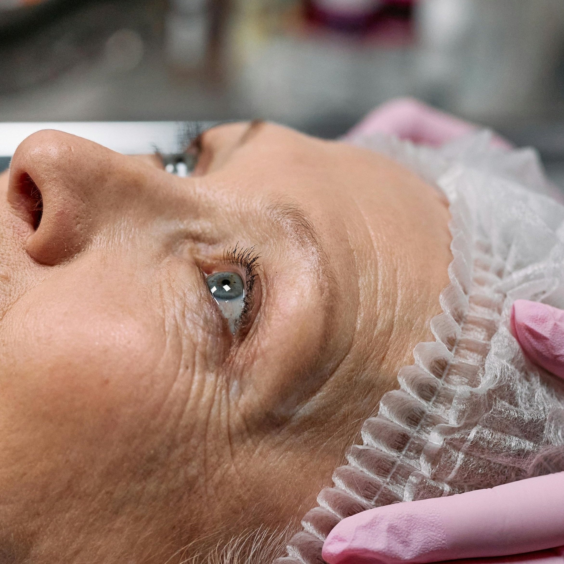 The Role of Laser Treatments in Anti-Ageing: A Comprehensive Guide