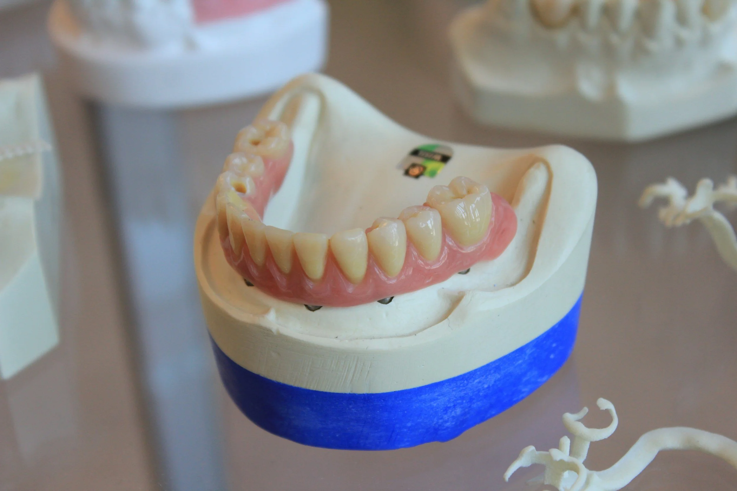 Signs It’s Time to Replace Your Dental Prosthesis