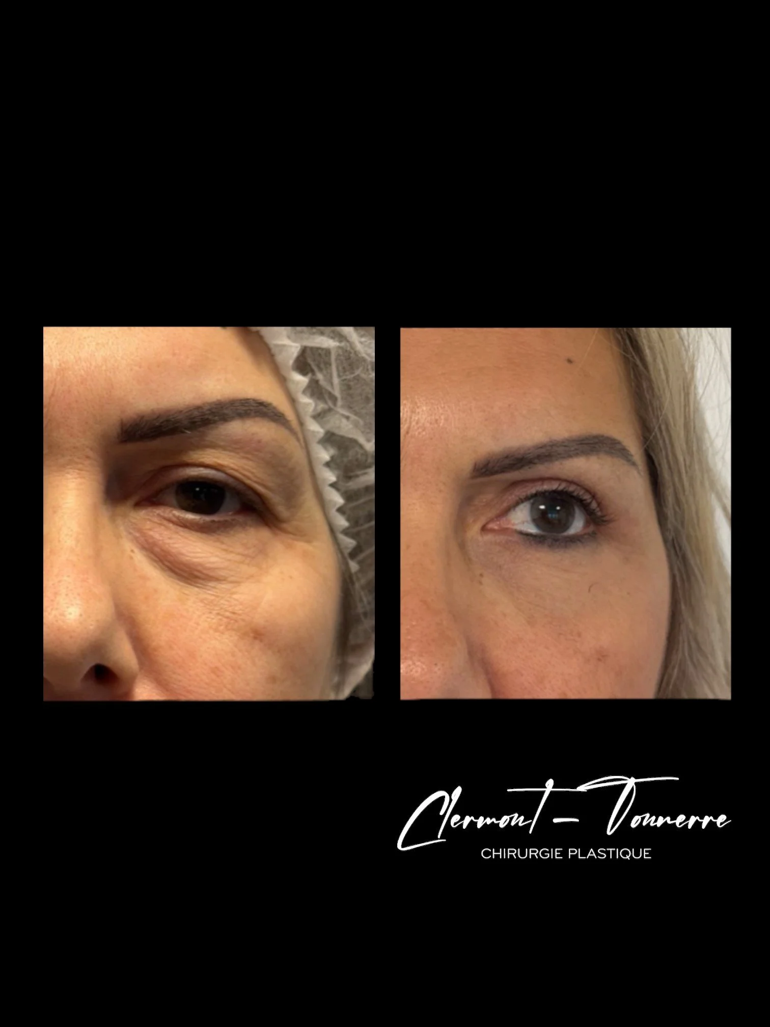 Avant et après une procédure esthétique du contour de l'œil, réalisée par Clermont-Tounerre, chirurgie plastique.