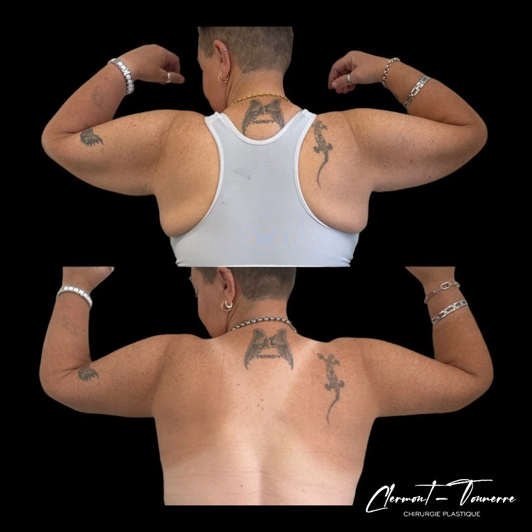 Brachioplastie