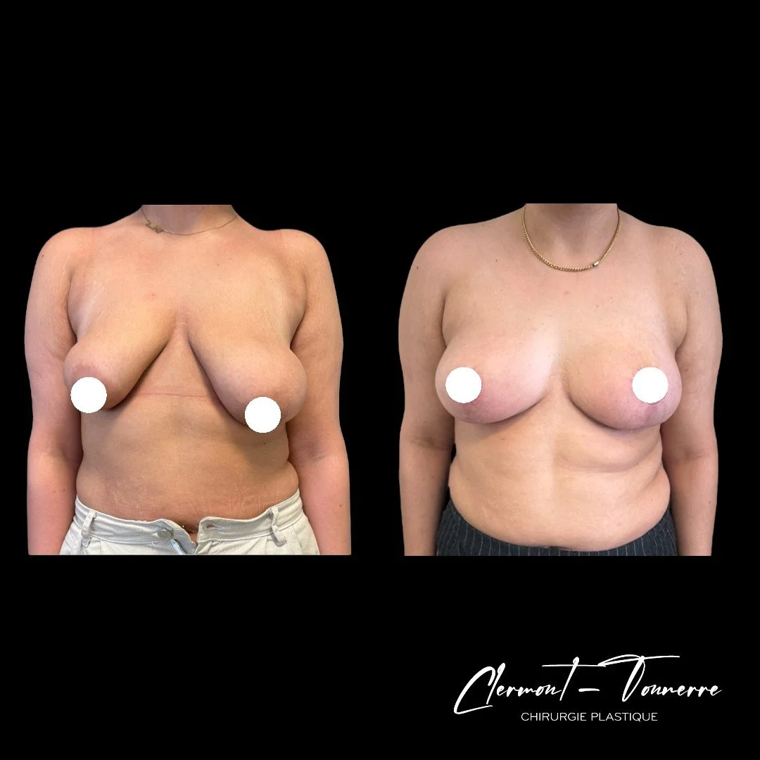 lipofilling mammaire avant et après