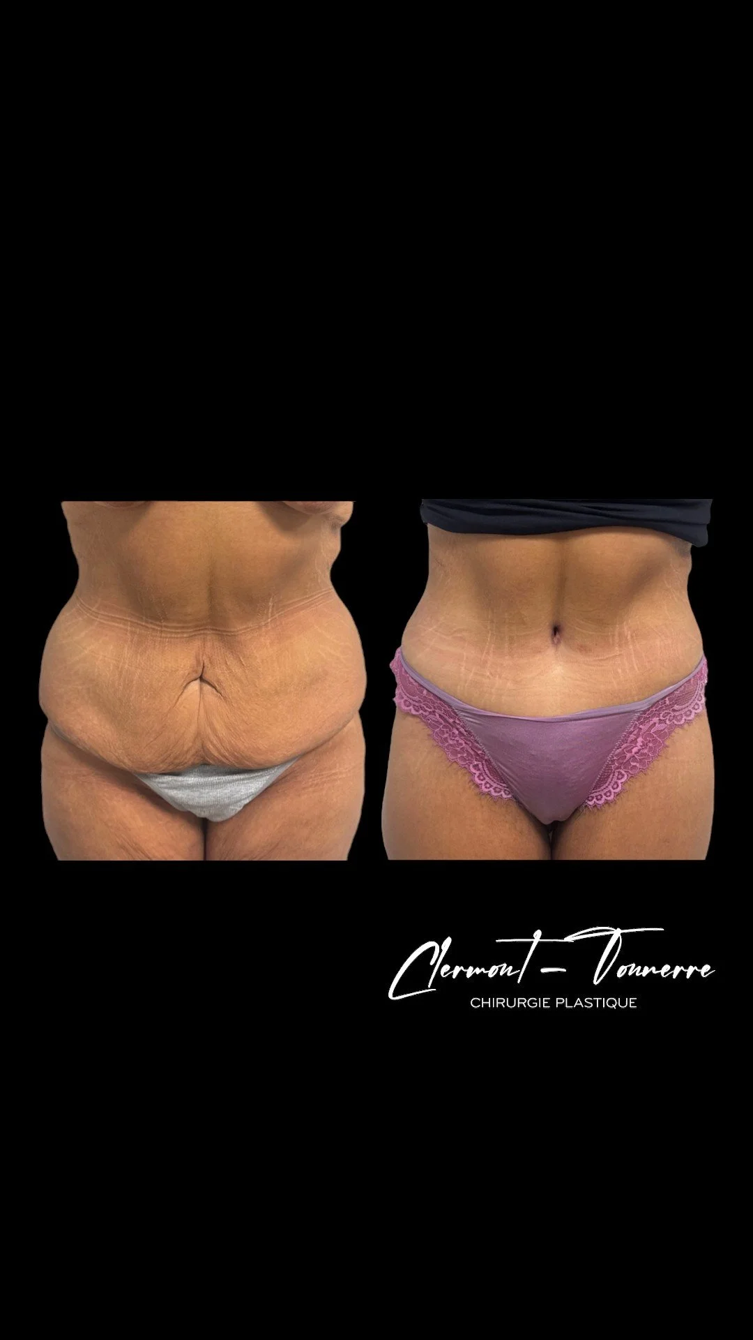 Bodylift