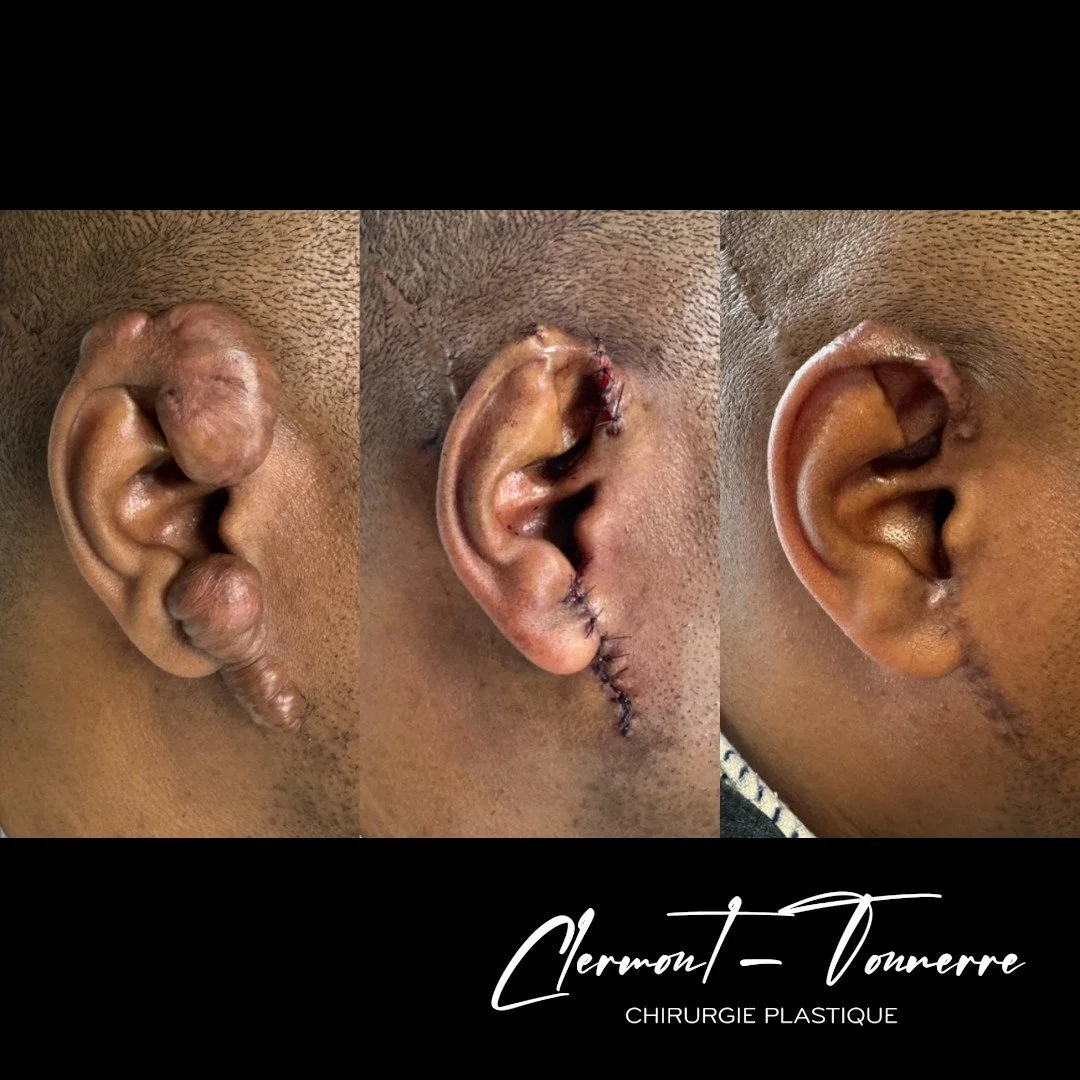Image montrant l'évolution de la chirurgie du lobe de l'oreille, de la reconstruction à la cicatrisation, réalisée par Clermon Tounare, spécialiste en chirurgie plastique.