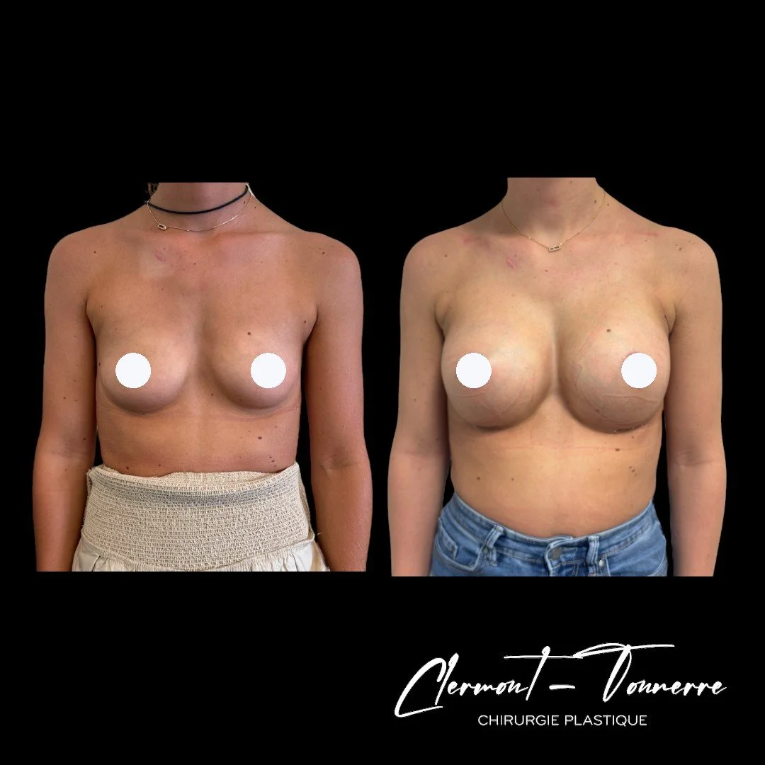 Résultat d'une augmentation mammaire par prothèse réalisée par le Dr de Clermont-Tonnerre, chirurgien plasticien à Paris, silhouette féminine et naturelle