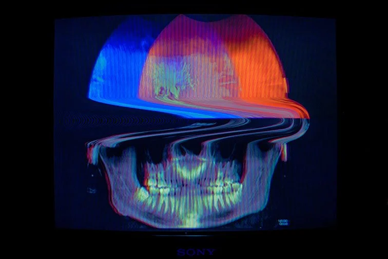 EYES AND MOUTH II. , 25’ 
 
Limited Edition of 9 and 3AP 
Signed by the Artist 
17” x 22” | “30 x 40” 
 
Digital Photography/Medical imaging | A second technical Self-portrait composed of Two Medical, i.e. “DICOM” files: 1: Optometrist’s stereoscopic