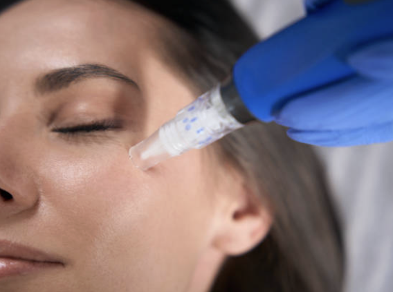 Microneedling pen gliding across the cheek