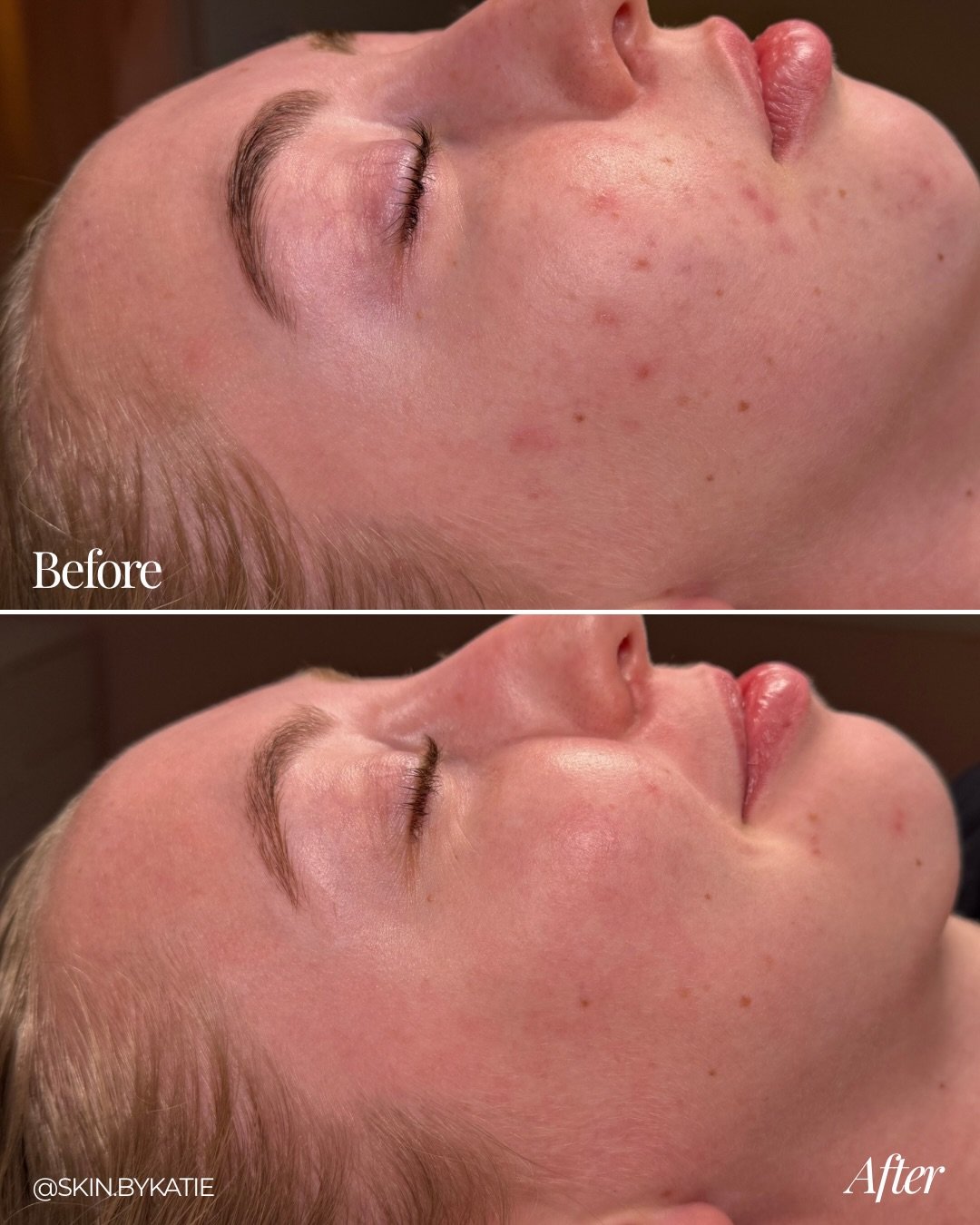 This client and I wanted to focus on managing hormonal breakouts and overall skin health! A solid regimen and treatments spaced out every 6 weeks did the trick!✨

Ready to change your skin? Book a consultation at the link in my bio😌

#acnetreatment 