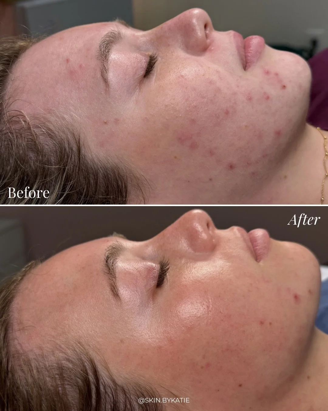 I love before &amp; afters!!🥳

Clearing acne take time, discipline, &amp; consistency! The third slide is a perfect example of how it can get worse before it gets better. Purging during the clearing process isn&rsquo;t fun but it&rsquo;s only tempor