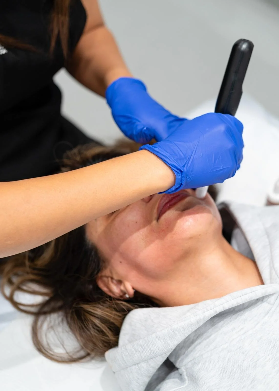 Microneedling: Your Skins Secret Weapon After 30!