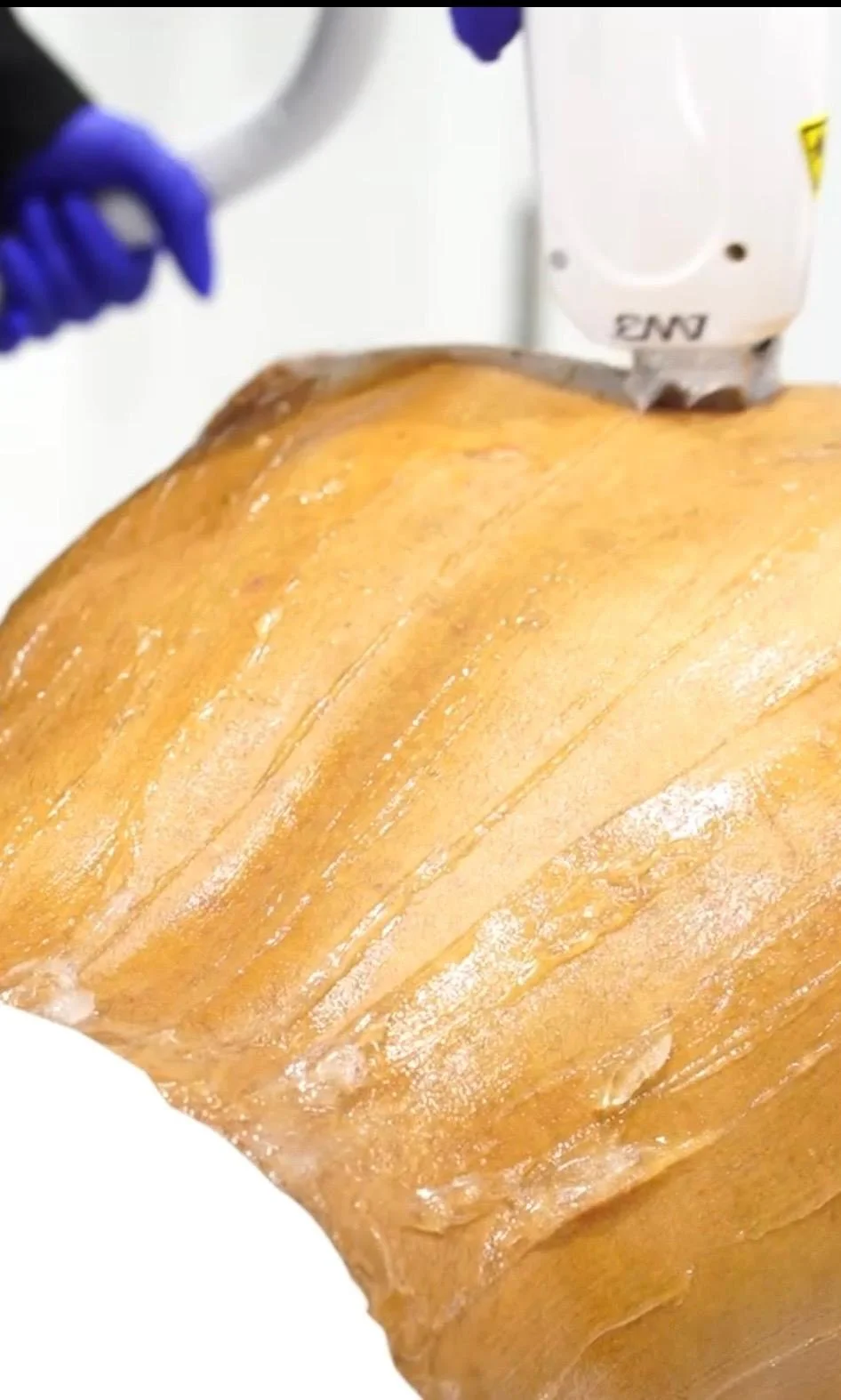 Laser Hair Removal: The Treatment You’ll Wish You Started Sooner