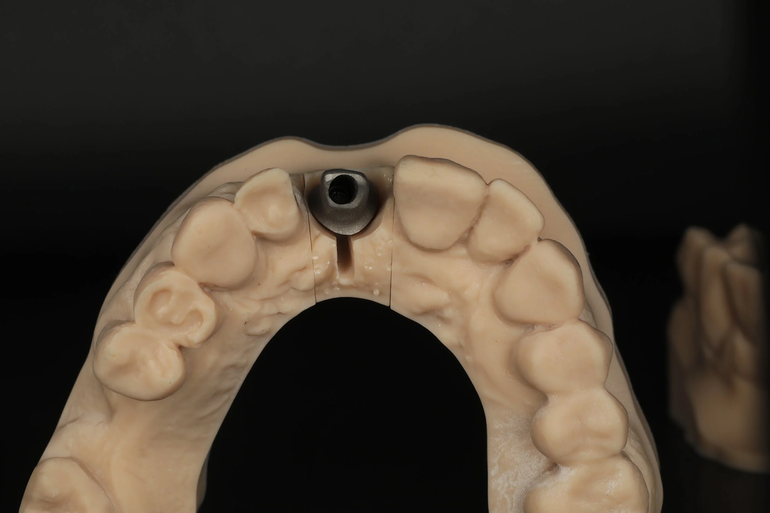 A dental model of the upper jaw with teeth, showing a dental implant post in the center.