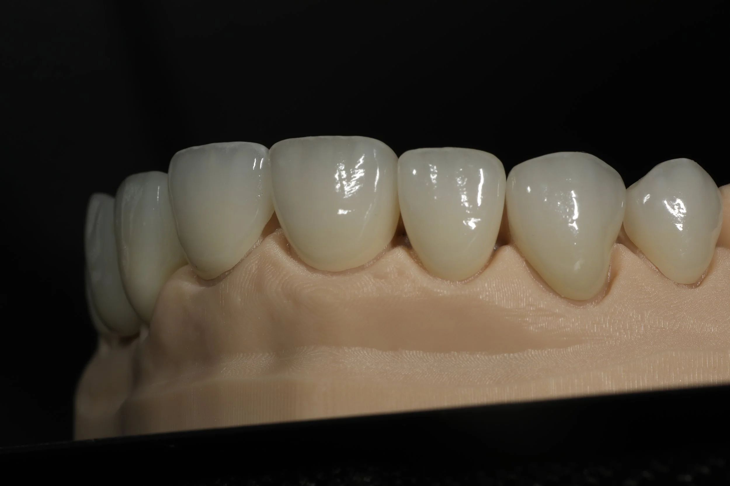 Close-up of a dental model showing upper teeth with dental crowns or veneers on the front teeth.