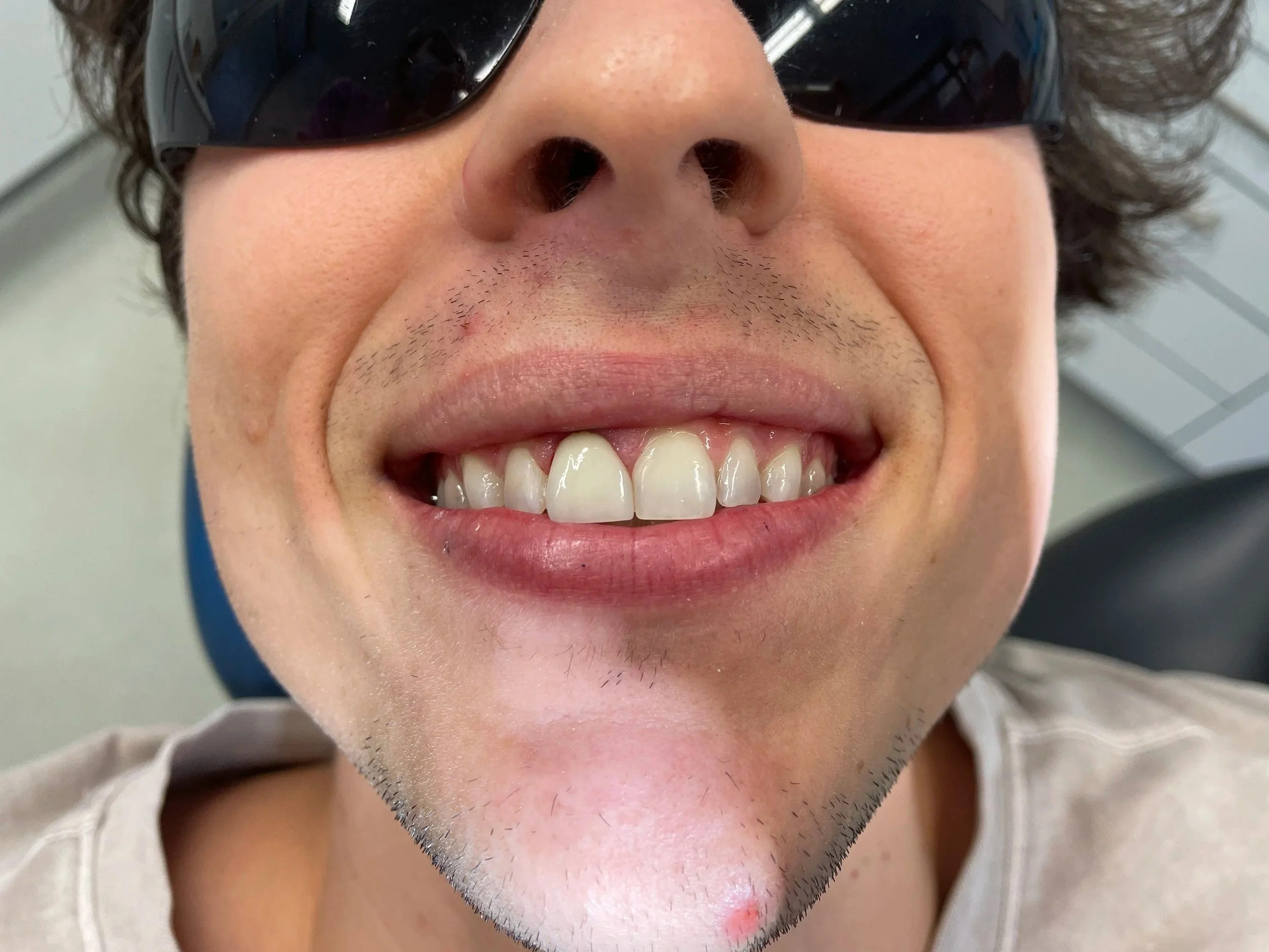 Close-up of a single veneer in the mouth showing a very accurate shade match