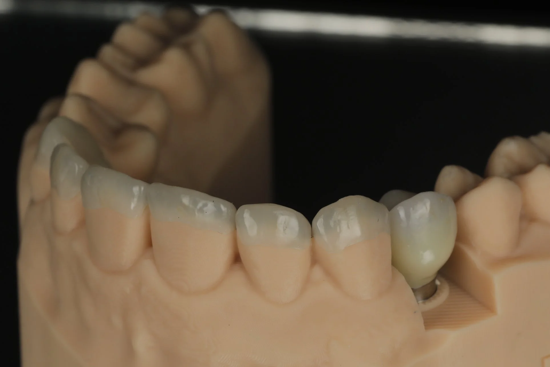 Close-up of a dental model showing upper teeth with some restorations against a black background, labeled 'Lisa Boulis'.