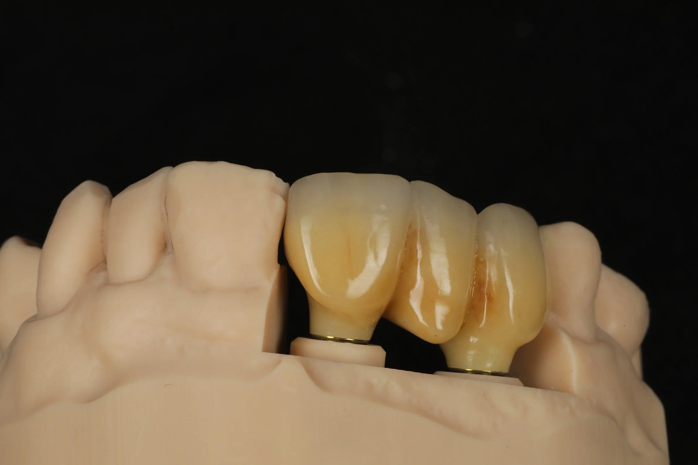 Close-up of a dental model showing a set of teeth with a dental crown on one of the molars against a black background, with part of a book or card visible at the bottom.