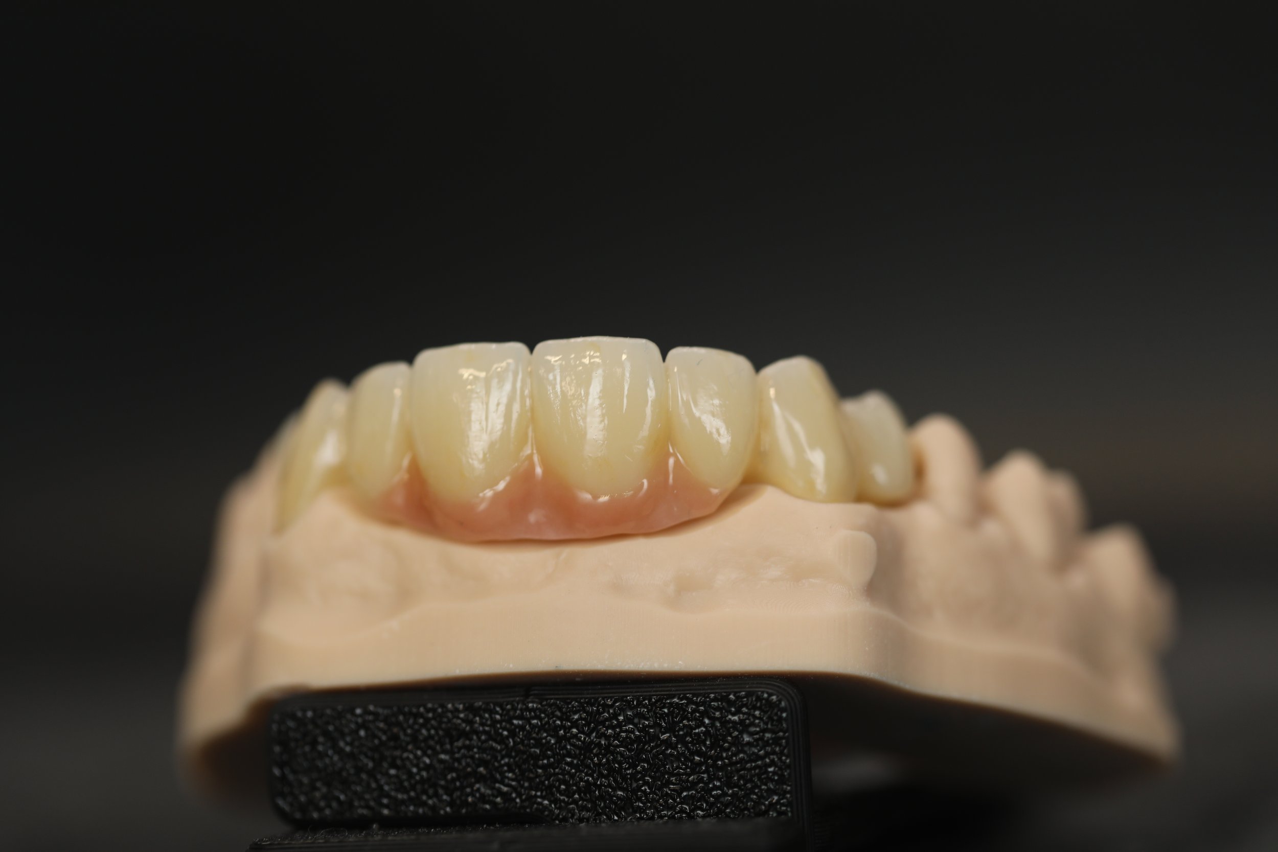 Dental Anterior Bridge fixing gingiva deficiancy, zirconia monolithic with gingival layering