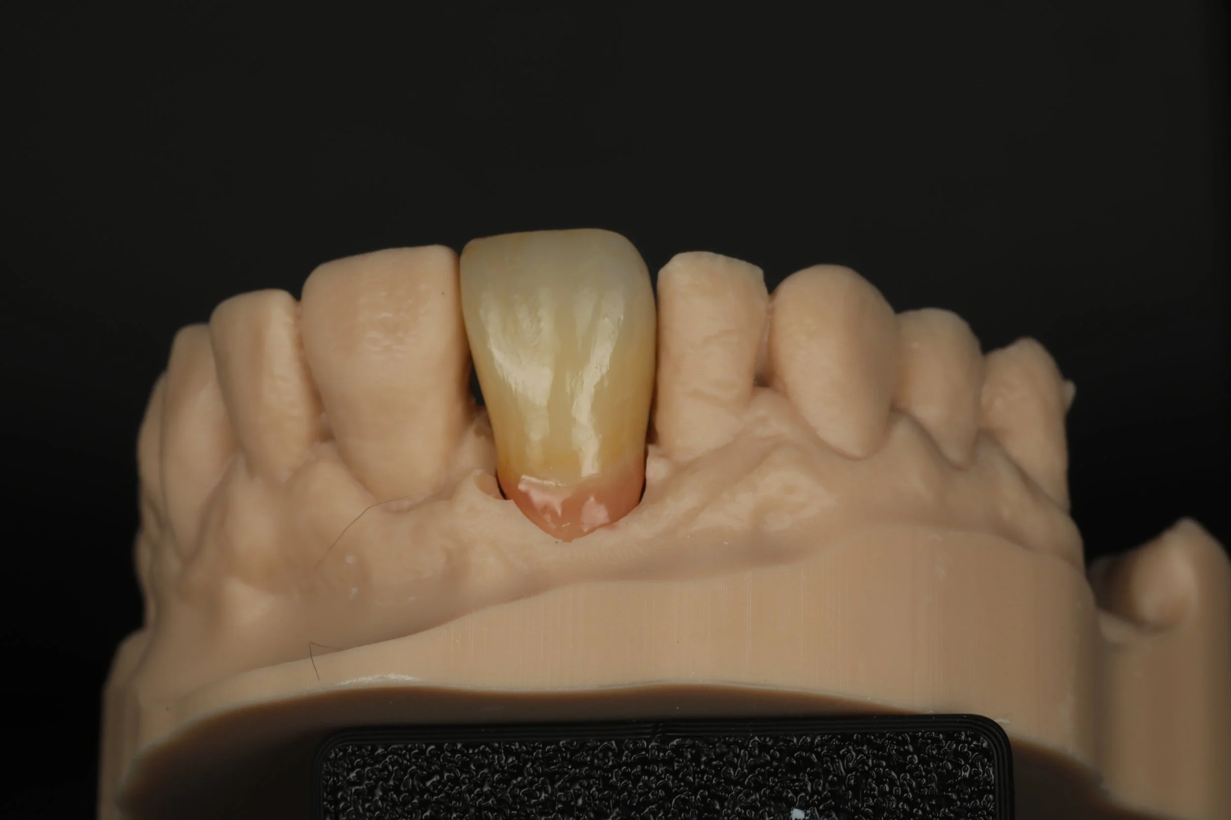 Dental Implant place too low and buccal with gingival deficiancy fixed with custom titanium abutment and gingival porcelain