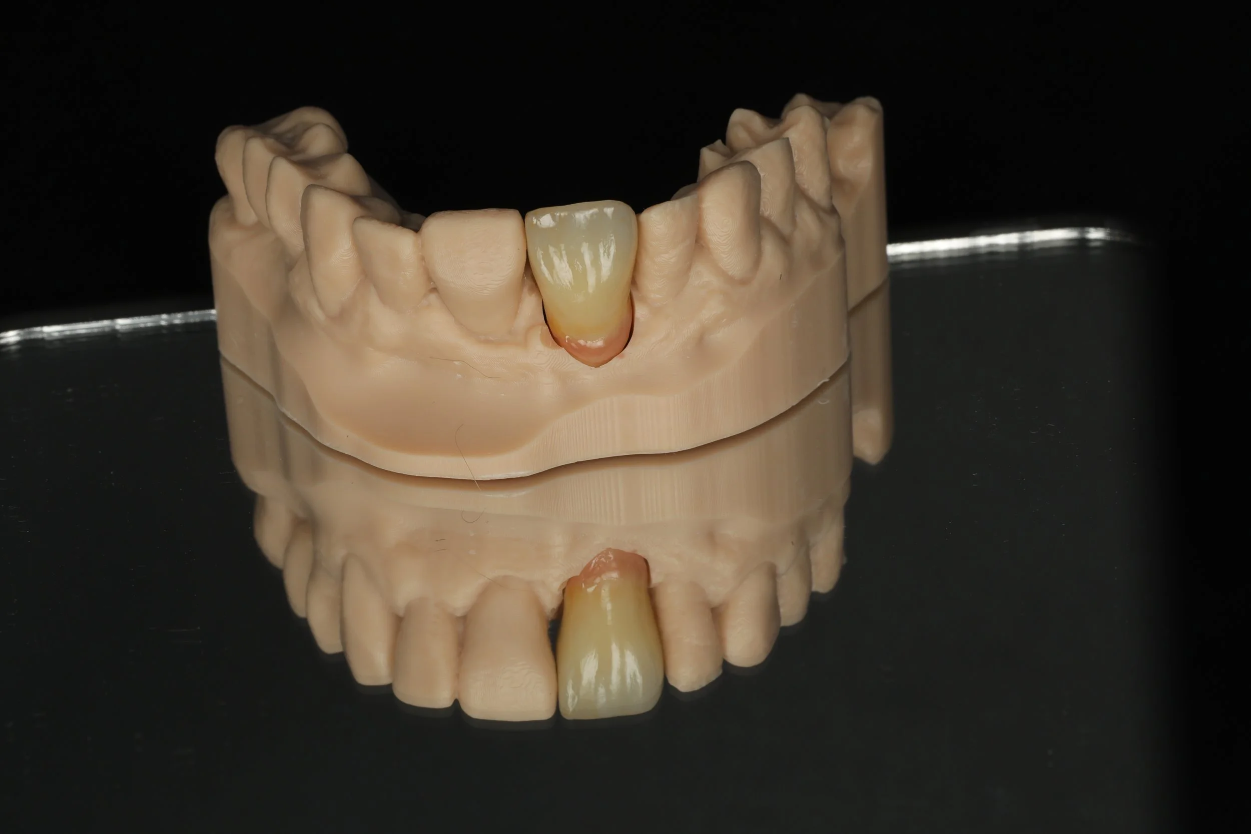 A dental model displaying a set of artificial teeth, with one tooth visibly different in color, possibly indicating a crown or veneer, against a black background.
