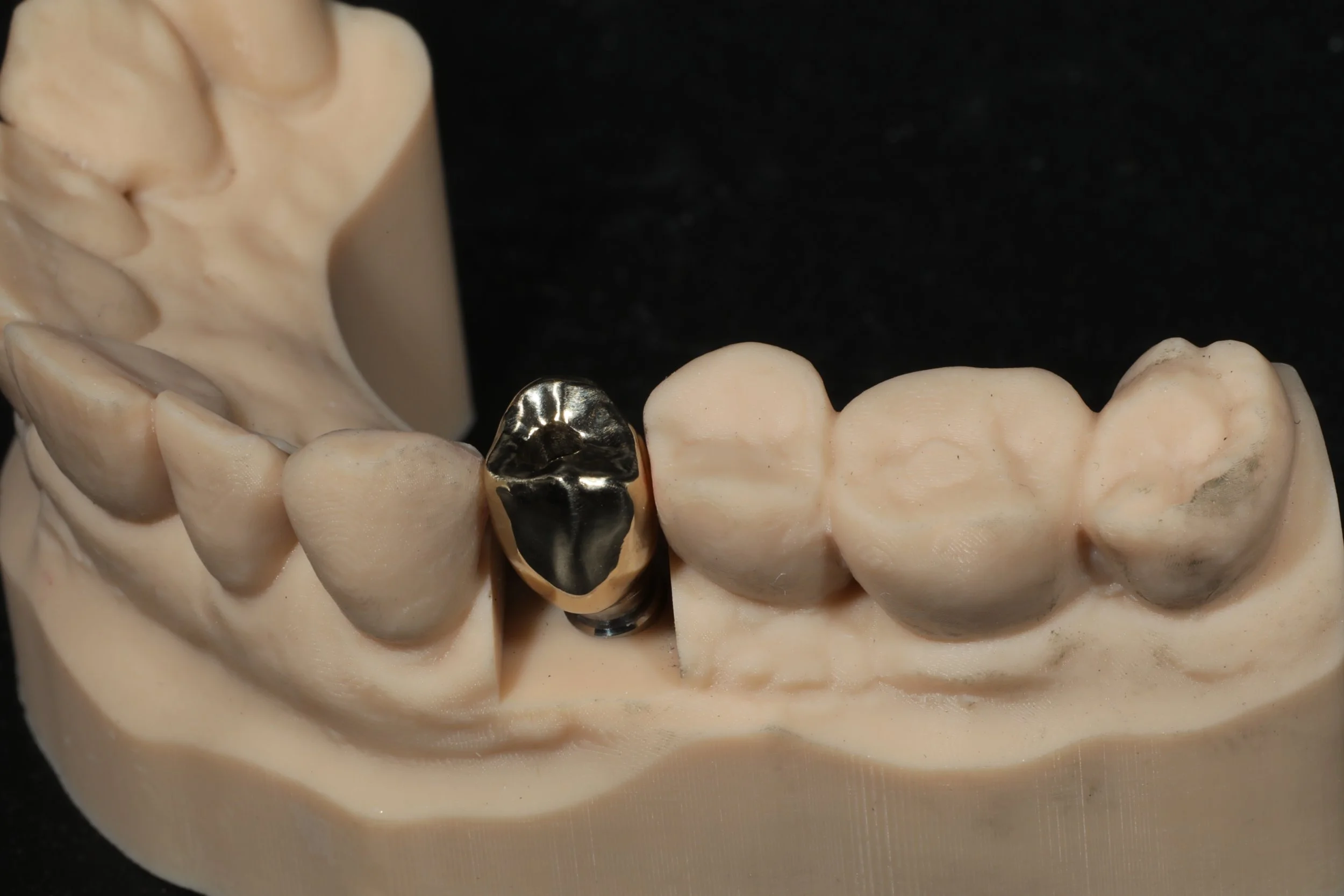 A dental model of teeth with a metal dental crown on one tooth.