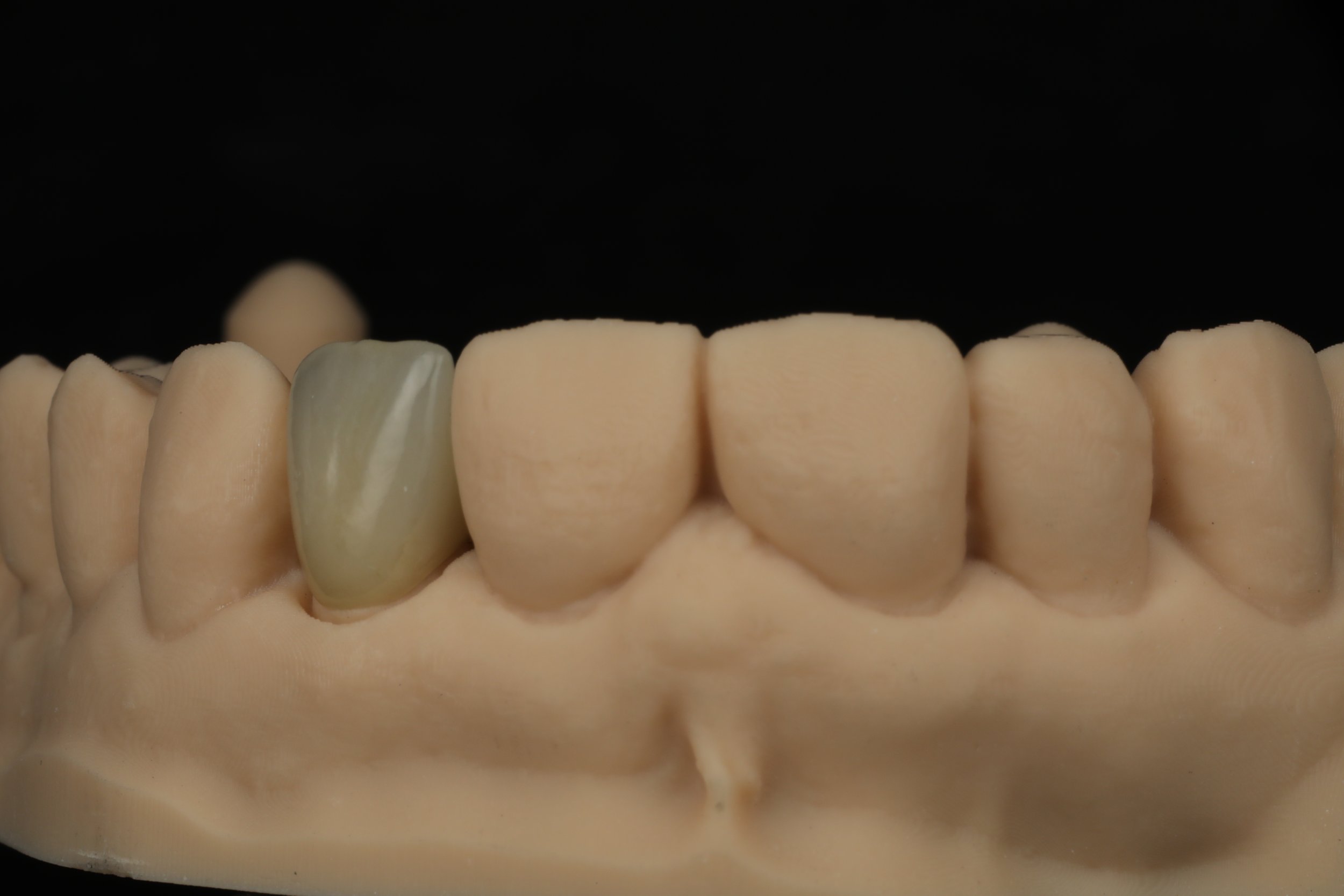 SIngle anterior Crown