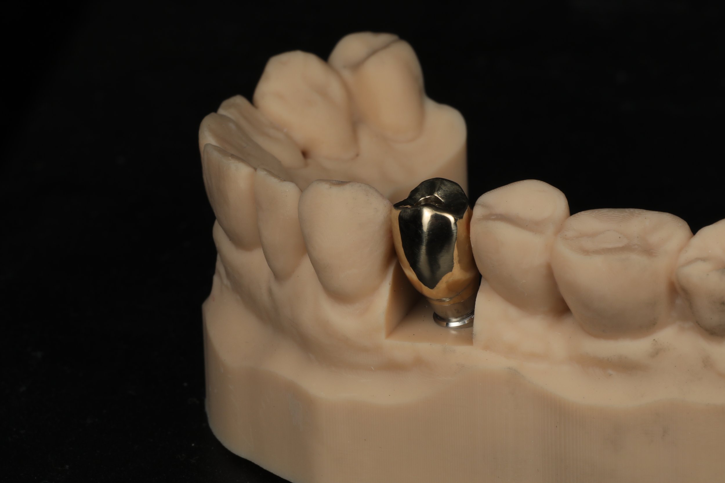 A dental model of upper teeth with a dental implant and a metal gold crown on the premolar