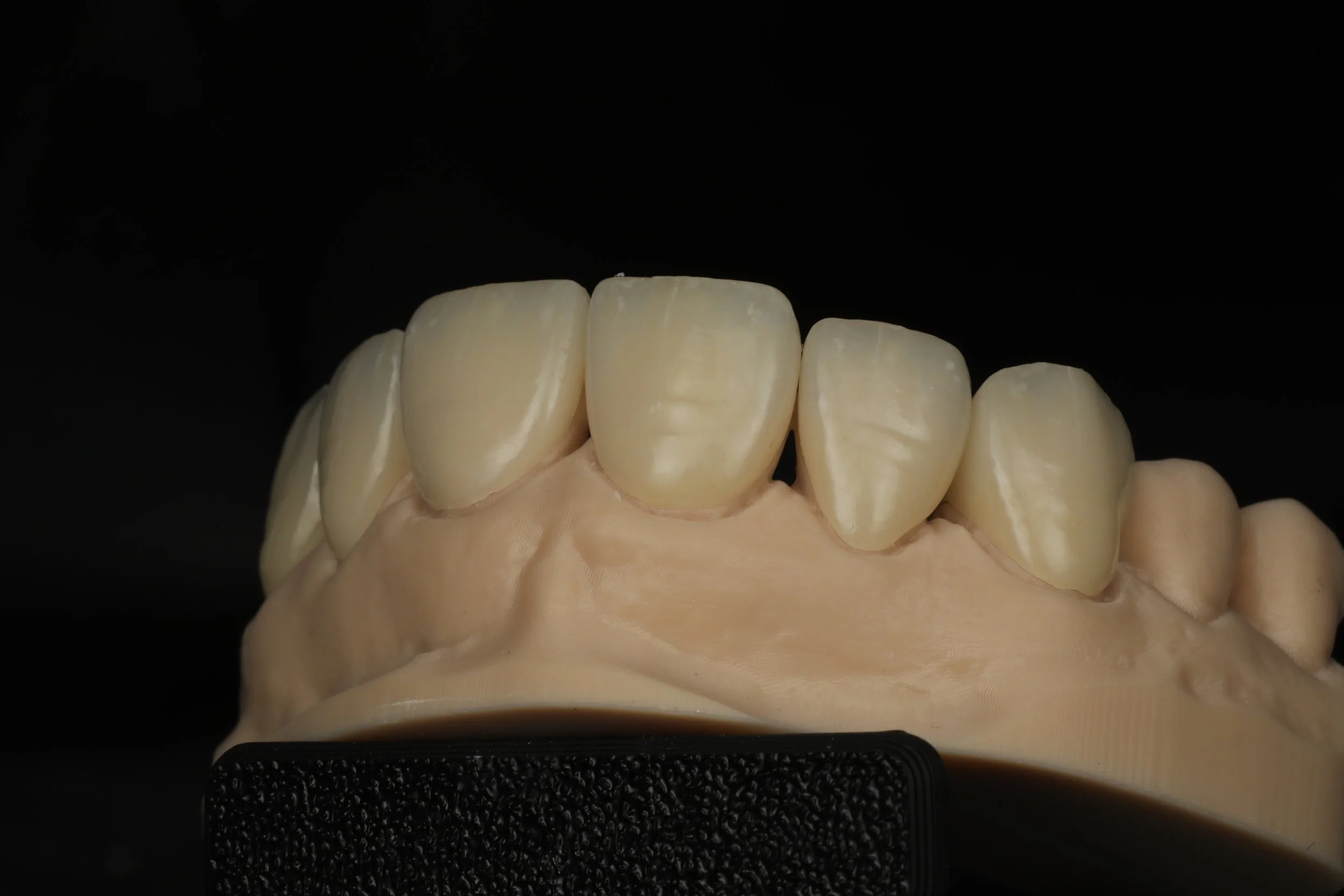 A dental model showing a set of upper front teeth with a beige gum line against a black background.
