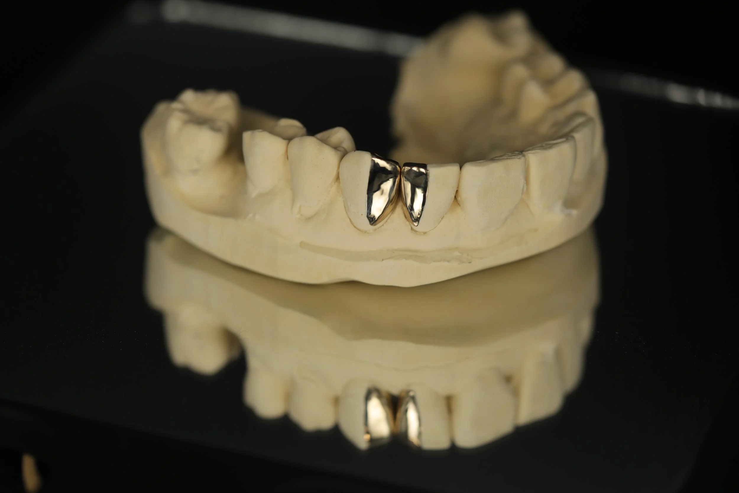 A dental model of teeth with two gold dental crowns on the front teeth, placed on a reflective black surface.