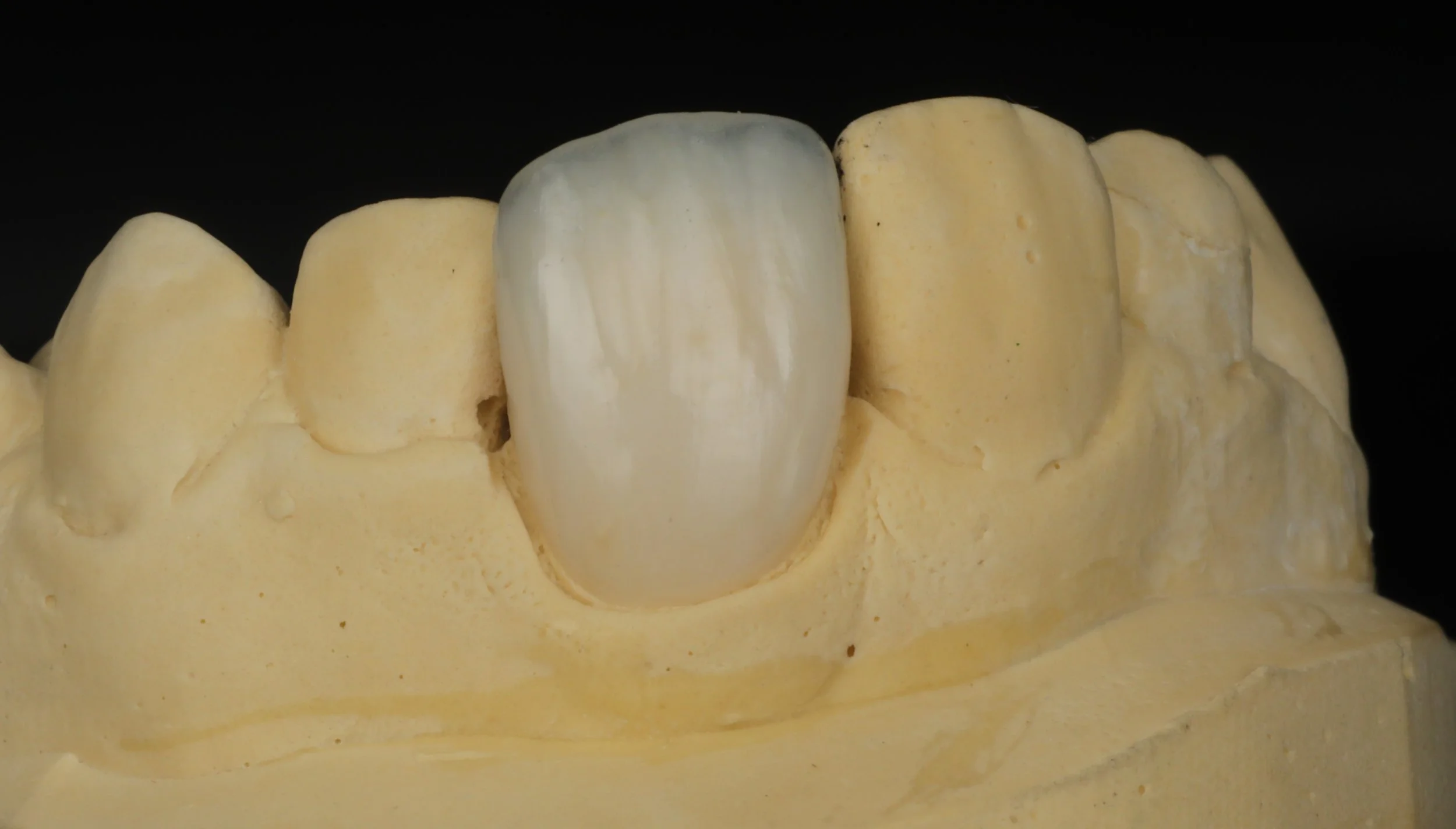 Emax crown with layering porcelain, Close-up of a row of teeth with a ceramic or dental crown on one of them, against a black background.