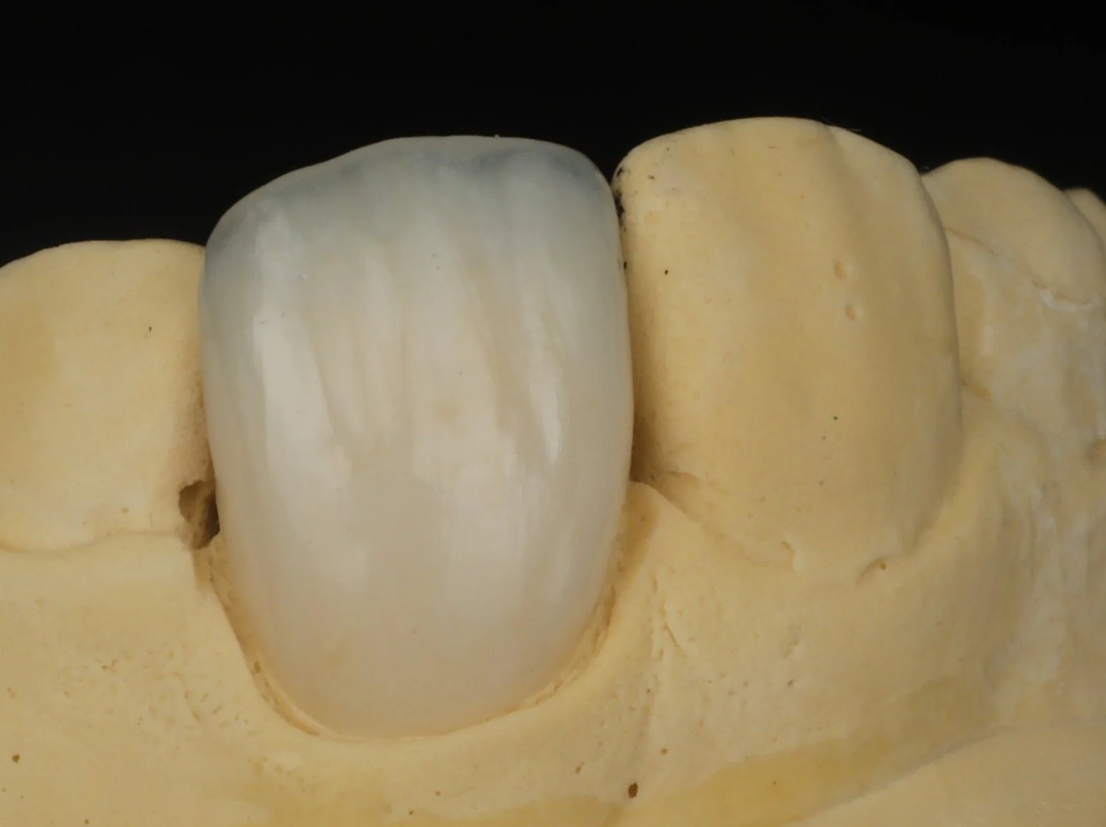 Emax crown with layering porcelain, Close-up of a row of teeth with a ceramic or dental crown on one of them, against a black background.