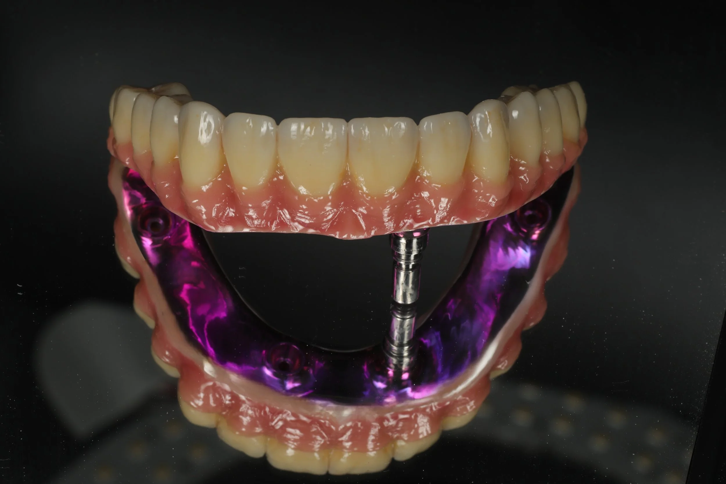 Implant supported full arch restoration monolithic zirconia with porcelain layered gingiva