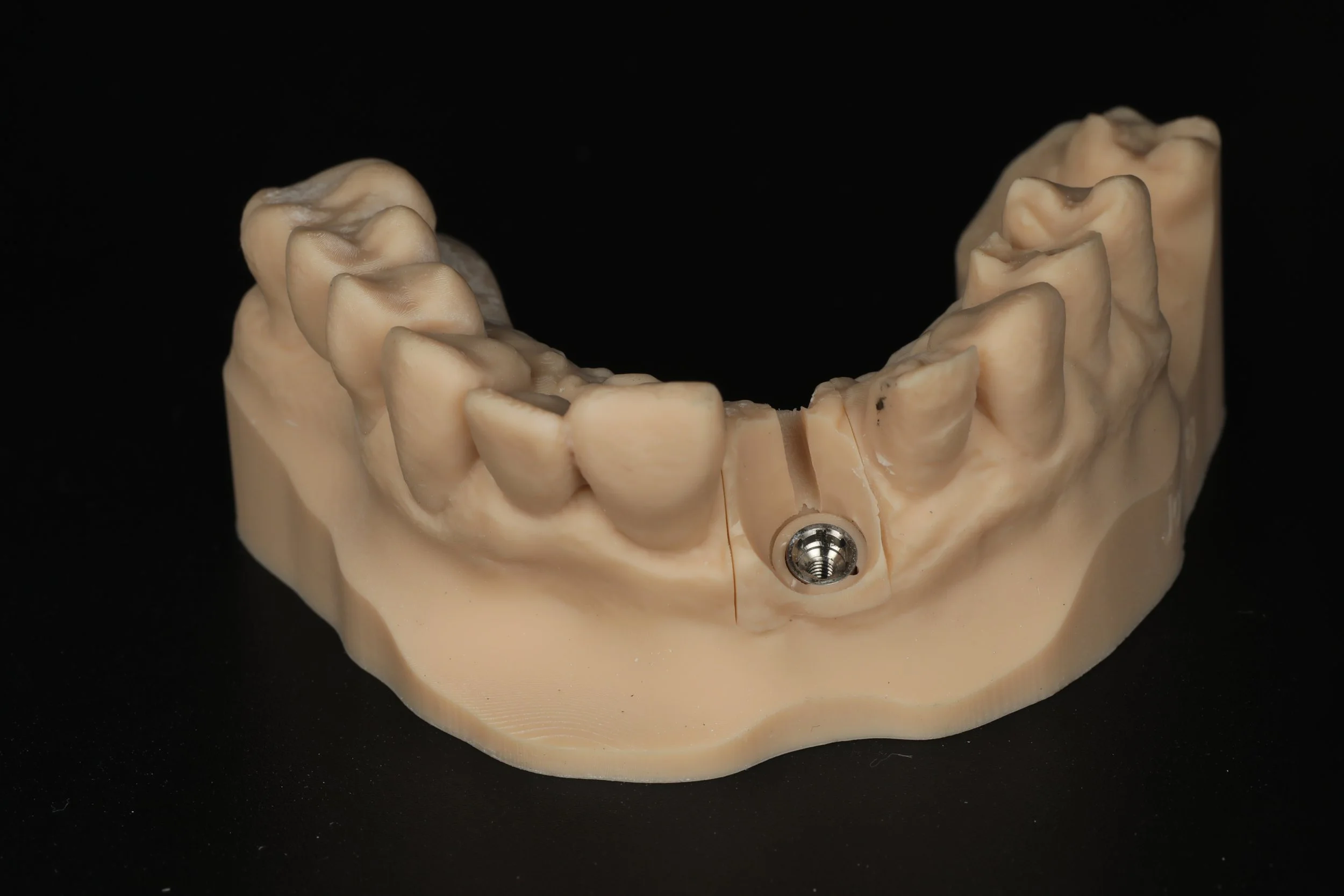 A dental model of the upper jaw with a dental implant visible at the center, set against a black background.