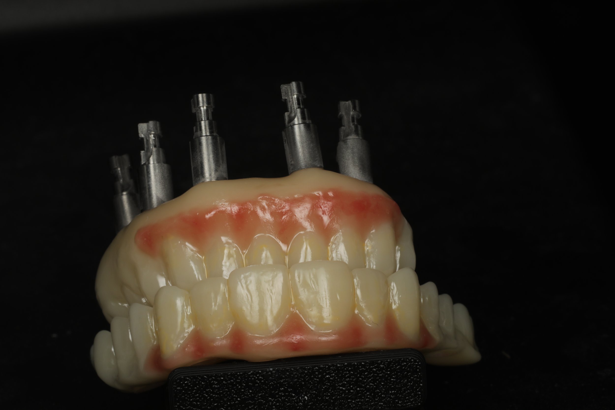 A dental model or denture with three dental implant abutments attached, against a black background.
