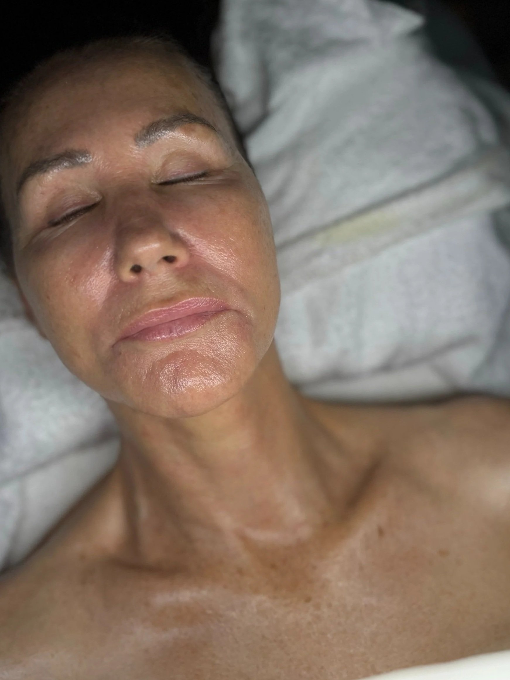 Facial for hormonal skin changes during perimenopause or menopause – Gold Coast skincare