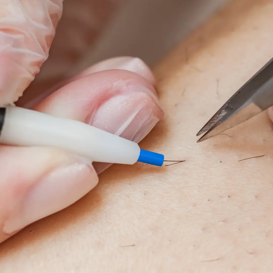 Why Professional Electrolysis Training Matters for Safe &amp; Effective Results