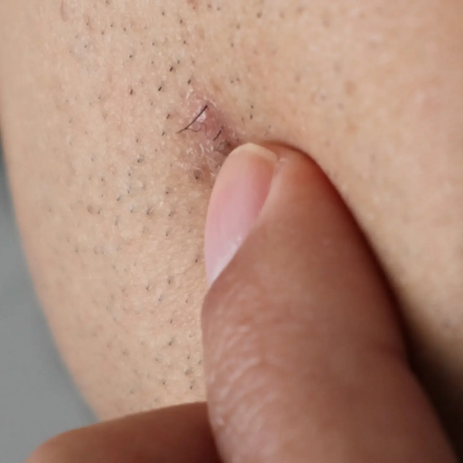 Aftercare for Facial Hair Removal to Prevent Irritation and Ingrown Hair