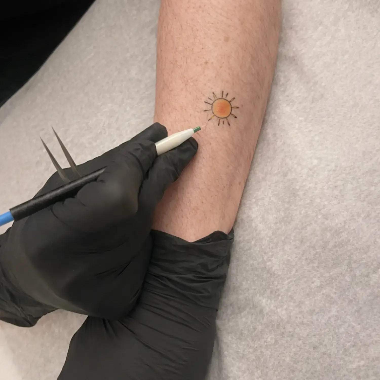 Electrolysis Over Tattoo for Safe and Permanent Hair Removal
