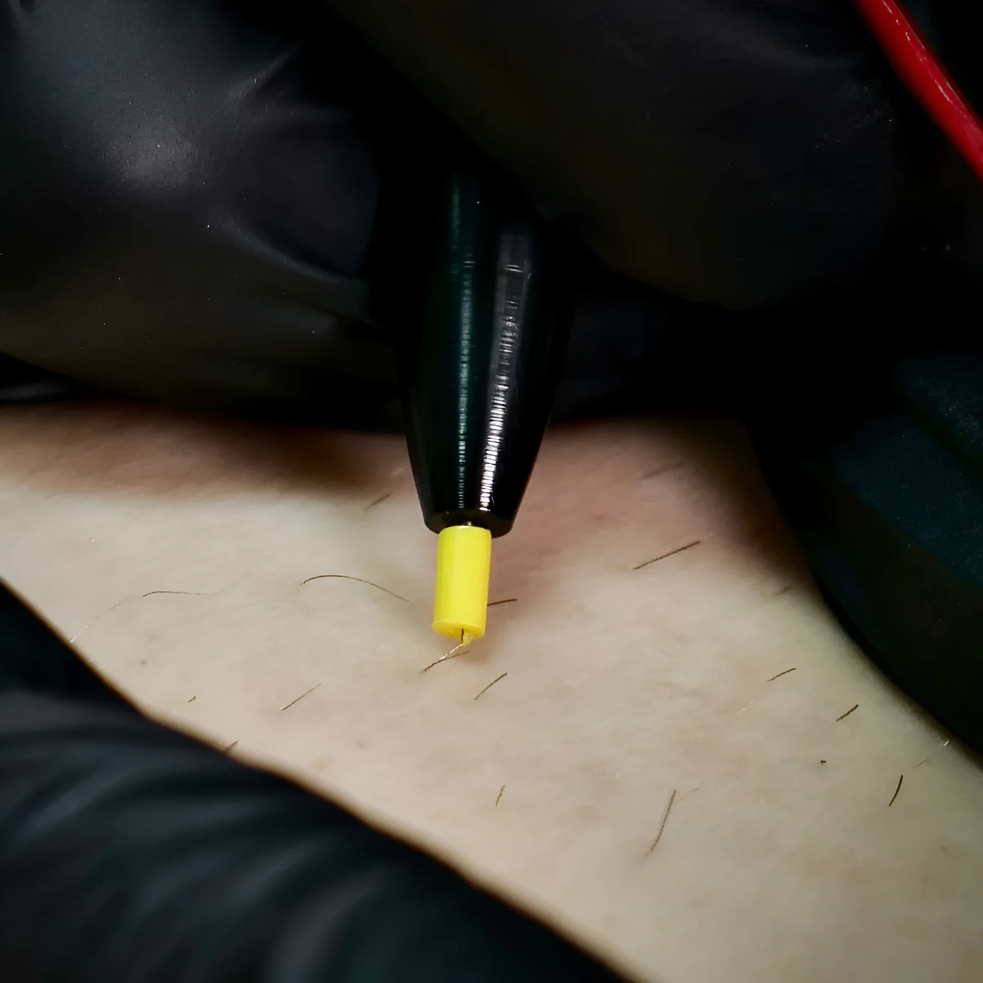 Can Electrolysis Permanently Prevent Ingrown Hair?