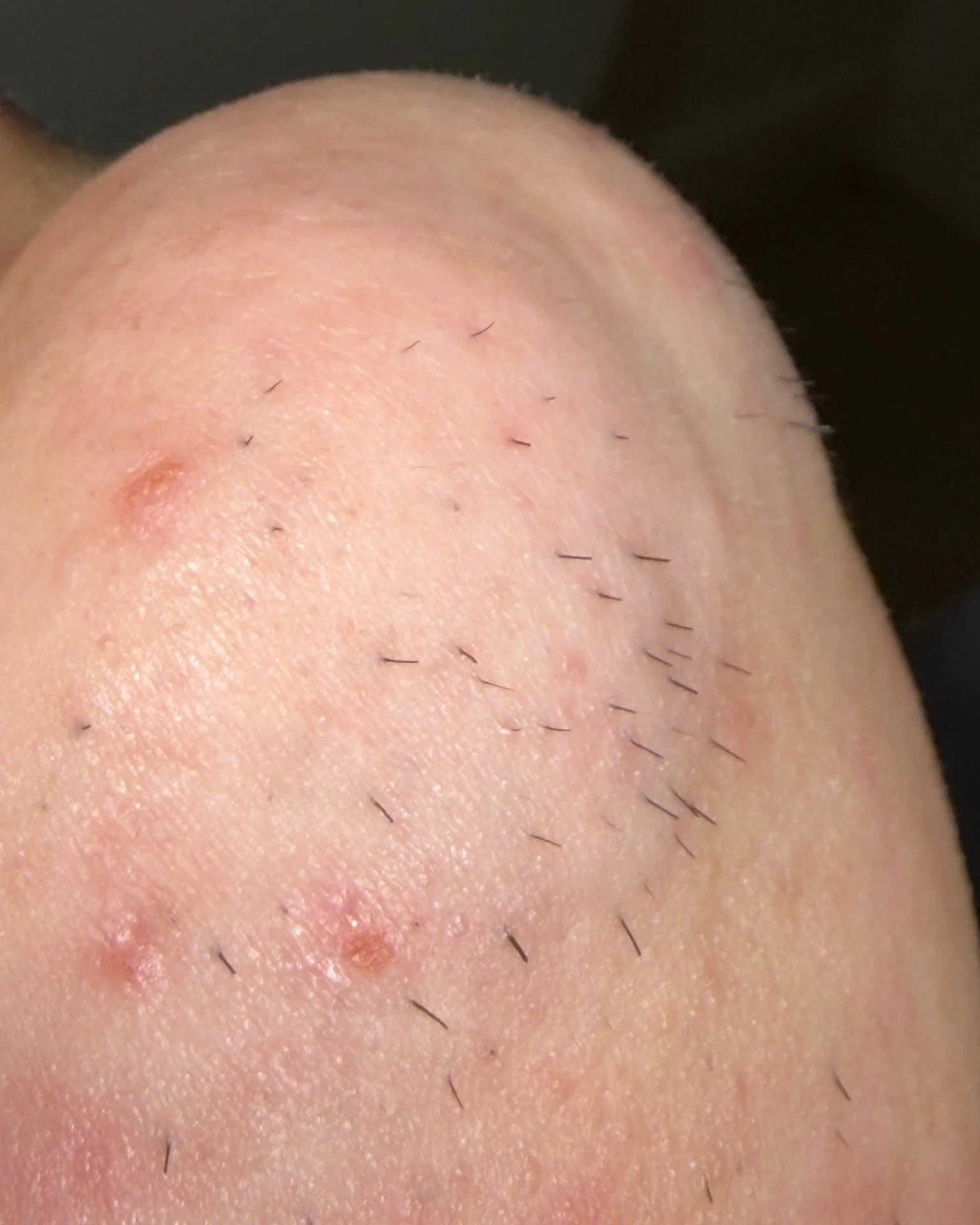 Ingrown hairs gone for good ✨
Swipe to see the before ➡️

Electrolysis doesn&rsquo;t just treat ingrown hairs, it eliminates them at the source by destroying the hair follicle. No more inflammation, no more bumps, no more recurring irritation.

Wheth